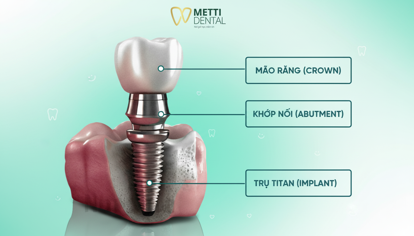 Trồng răng Implant và cấu tạo chi tiết của trụ Implant trong phục hình răng hiện đại