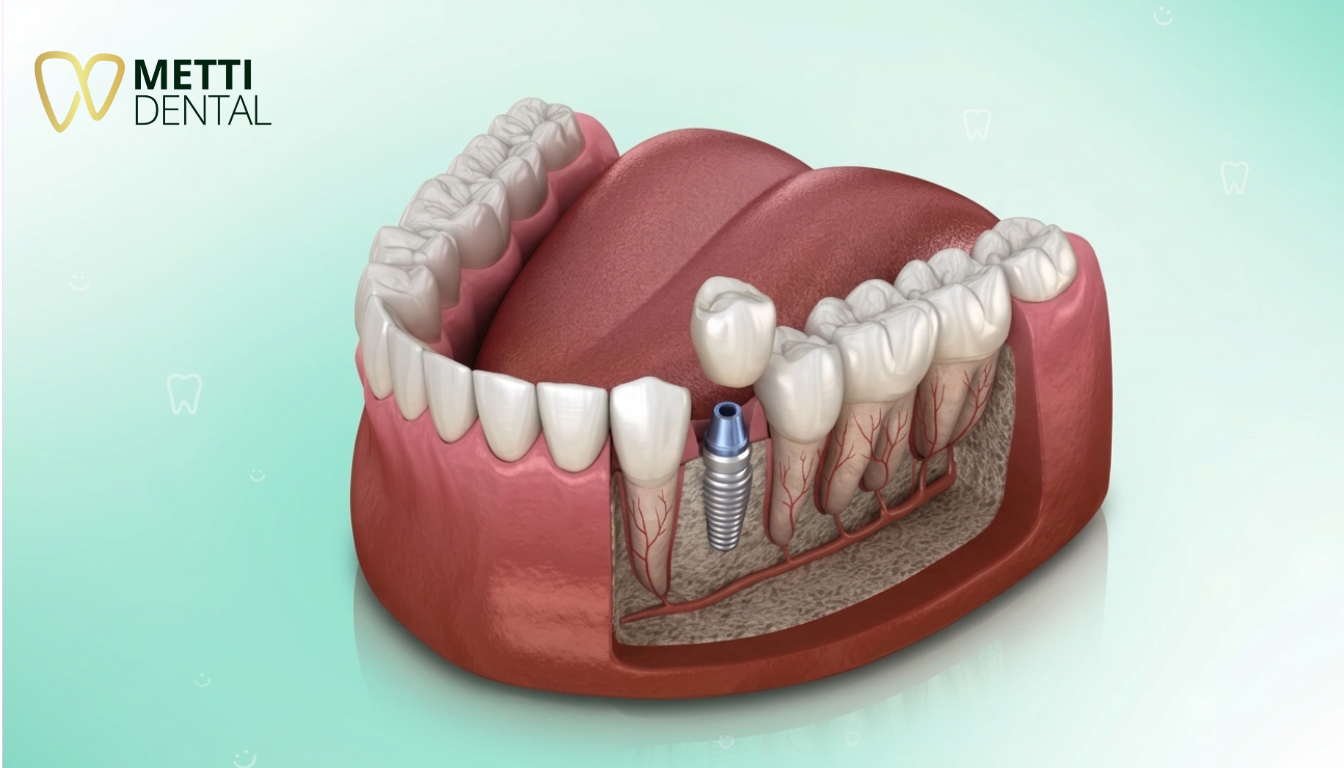 Trồng răng Implant dành cho ai  Những trường hợp nên và không nên thực hiện Implant