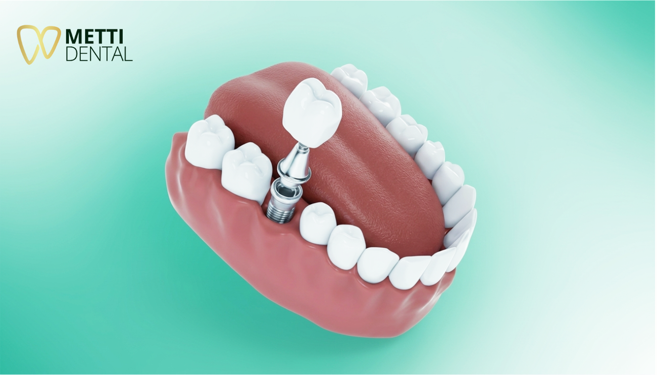 Trồng răng Implant với các dịch vụ phổ biến hiện nay giúp phục hồi răng mất hiệu quả
