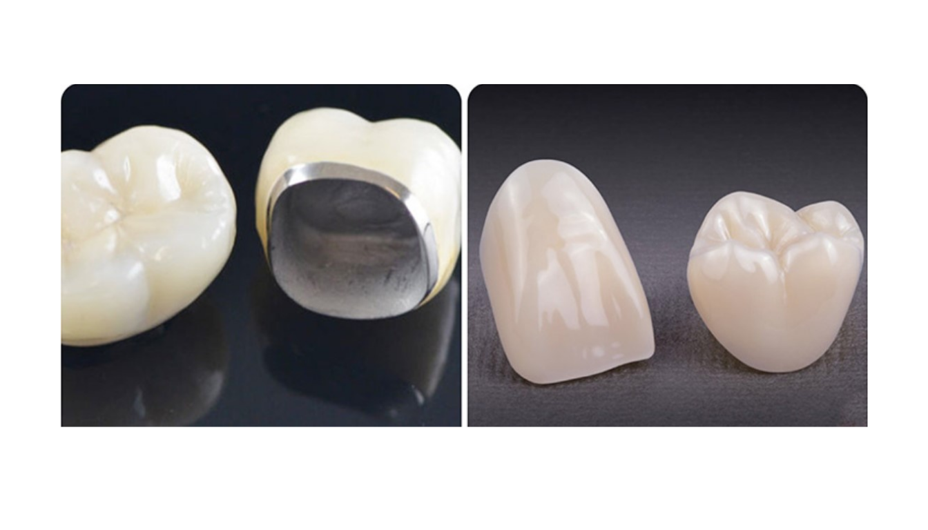 Răng sứ thẩm mỹ với sự khác biệt giữa răng sứ kim loại và răng toàn sứ