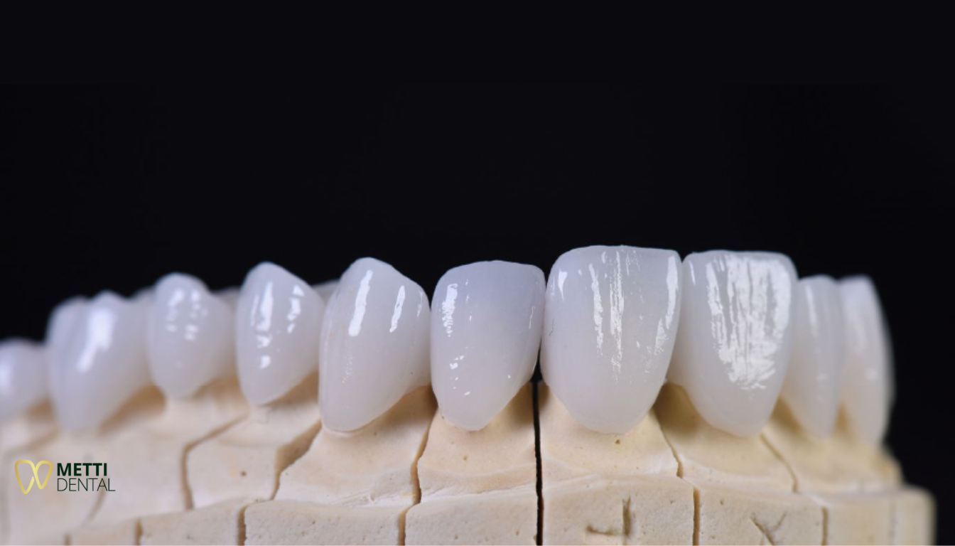 Răng sứ thẩm mỹ HT Smile Nacera cao cấp với độ trắng sáng và độ bền ấn tượng