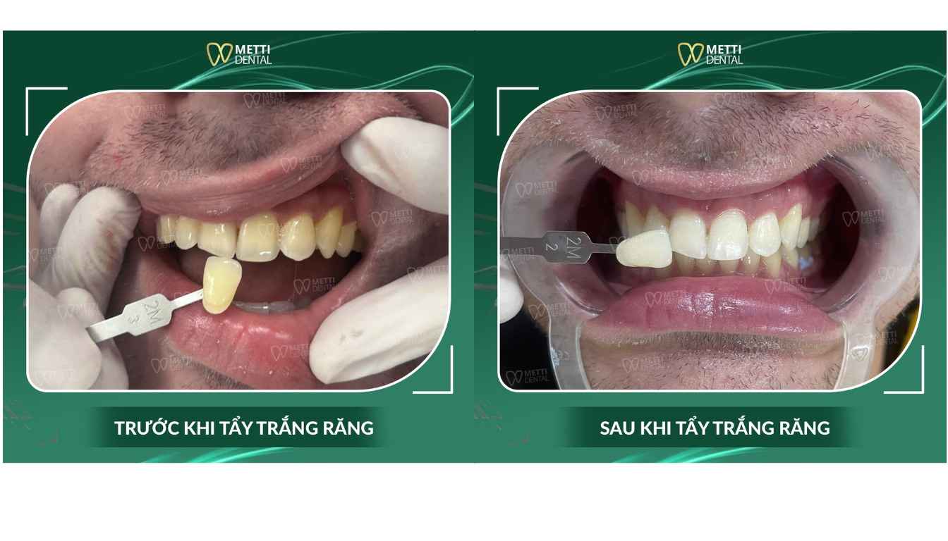 Nha khoa tổng quát tại Metti Dental là lựa chọn uy tín nhờ chất lượng dịch vụ và công nghệ hiện đại