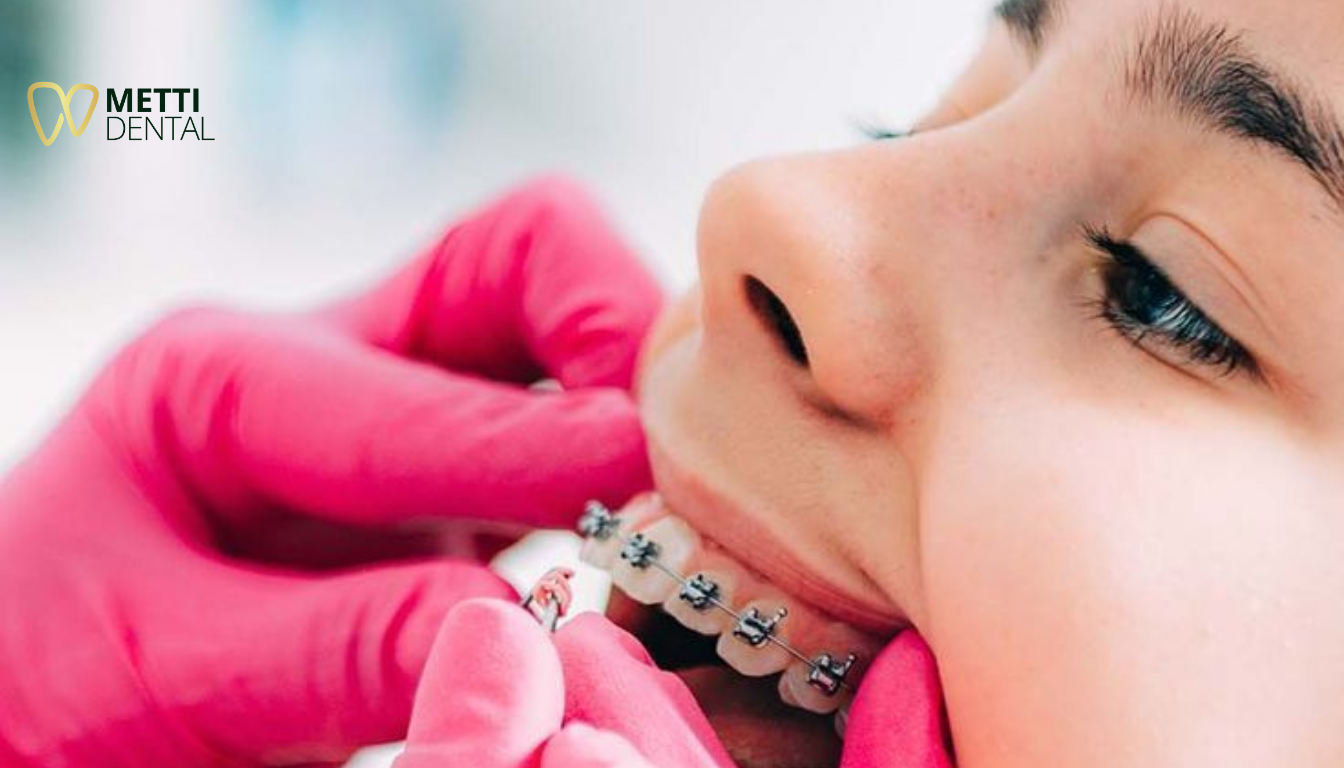 Những Trường Hợp Nên Niềng Răng Chỉnh Nha