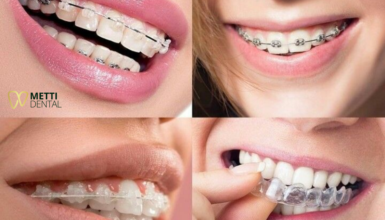 Các Phương Pháp Niềng Răng Phổ Biến Hiện Nay